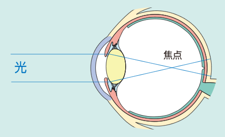 調節性近視のイメージ