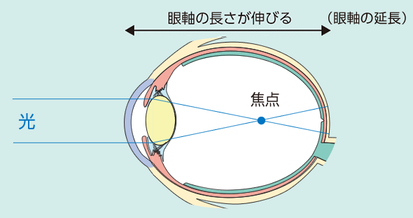 軸性近視のイメージ